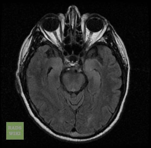 NMDA encephalitis (pécsi beteg) 16 éves lány Egy este halmozott GM convulsiók léptek fel Következő napokban komplex auditoros hallucináció Később agitált, inadequat érzelmek (aggresszív a szülei