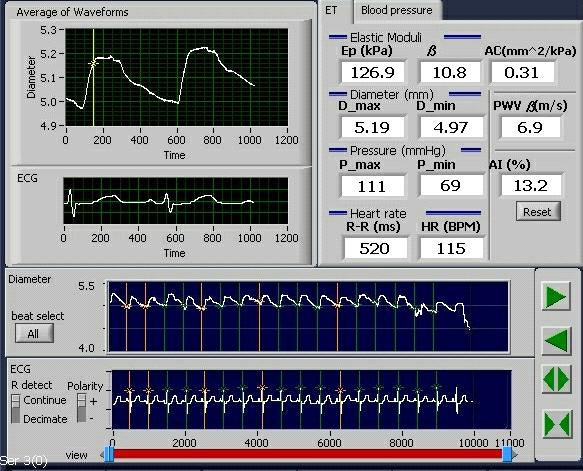 Beta values 4. ábra Bal ACC esetében végzett RF echo-tracking mérés eredeti regisztrátuma 9 éves progeria szindrómás gyermek vizsgálatából.