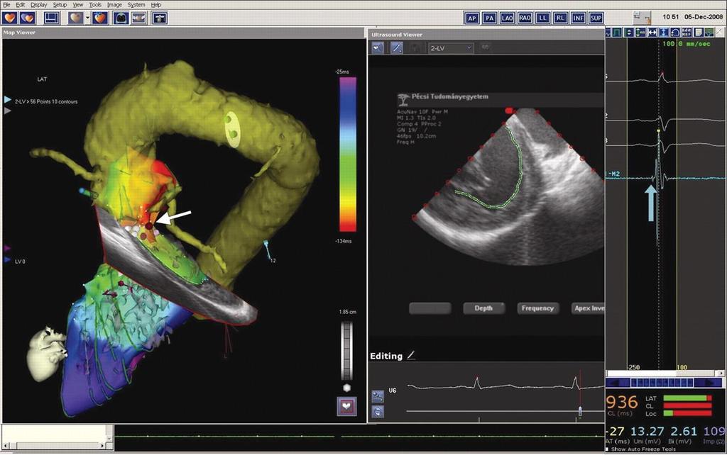 11. ábra Hibrid képalkotás, elektro-anatómiai térkép megalkotásához CartoSound rendszerrel (Biosense Webster, Inc, Diamond Bar, CA, USA).