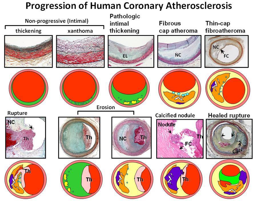2. ábra Az atherosclerosis során kialakuló plakkok AHA szerinti morfológiai besorolása megkülönbözteti a nem progresszív intima elváltozásokat és a progresszív atheroscleroticus elváltozásokat.