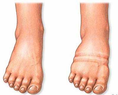 Oedema Megjelenése az egyes szervekben: Agyoedema Tüdőoedema Gégeoedema Bőr alatti oedema (anasarca) Testűri folyadékgyülemek: hydrothorax, hydropericardium, ascites Veseeredetű (periorbitalis)