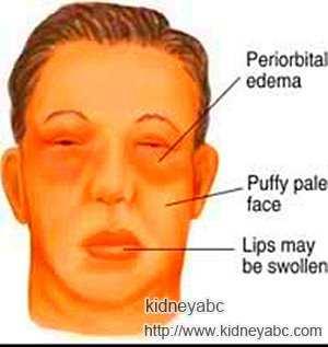 hypoproteinaemia.