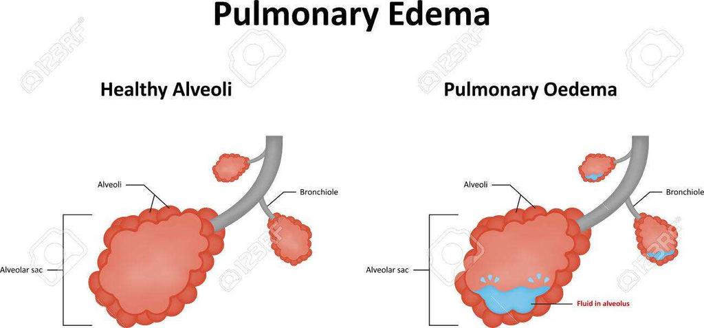 Pulmonaris oedema Az akut bal kamra elégtelenség következtében a hydrostaticus