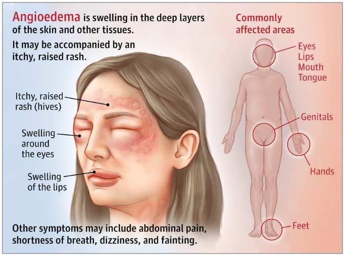 Angioedema A kis erek áteresztenek. A legveszélyesebb, ha a gégében történik: gégeoedema fulladáshoz vezet.