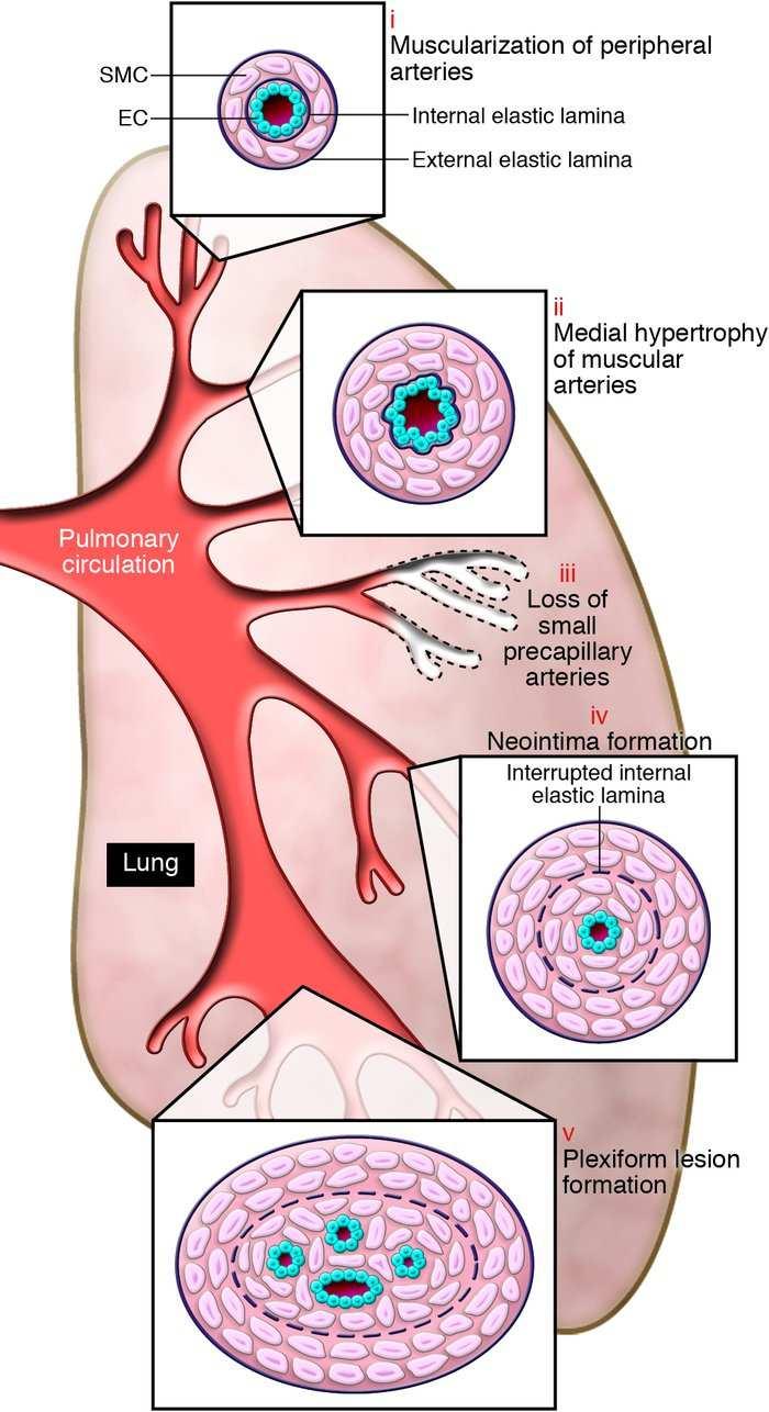 a vérkeringés következményeinek kis körében magas vérnyomás muskátli hipertónia kezelése