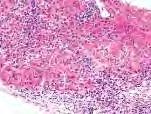 Az AIH klinikai jellemvonásai 75% nő 50% 40 év alatti * 40% a mortalitás féléven belül kezelés nélkül 30-40% akut hepatitisként kezdődik 30 % tünetmentes - kóros