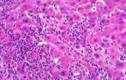 AIH diagnózis - aspartat aminotransferase (AST/GOT) - hypergammaglobulinaemia (>20 g/l) - autoantitestek (ANA, SMA, LKM, SLP) (8-9 %-ban + AMA = "overlap szindroma" (20 %-ban