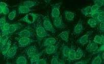 PBC patogenezis Immunológia: (GVH analóg?) Kóros MHC II expressio a biliaris epithelsejteken (BEC): Th1 válasz, és a sejtek CD95-mediált apoptosisa?