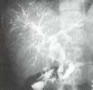 PSC diagnózis - cholestasis (szerum
