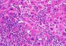 Overlap szindroma: AIH /PSC