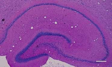 deformitását, mely a mediolaterális tengely rövidülésében és a gyrus dentatus