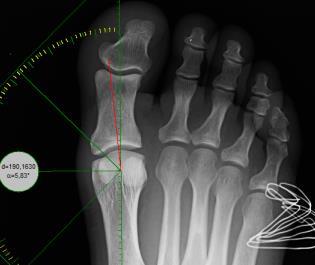-es metatarsus és az egyes ujj alappercének tengelye által bezárt szöget kell megállapítani. 19.