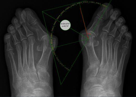 21. ábra: Egy hallux valgussal rendelkező 56 nő felvétele. A szögérték 46. Az ötös metatarsusok fejein egy-egy szezámcsont látható. 4.13.