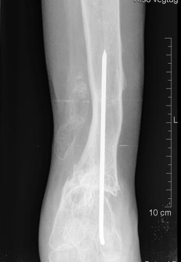 A csontok mésztartalma csökkent, és a medio-dorsalis lágyrészben inhomogén