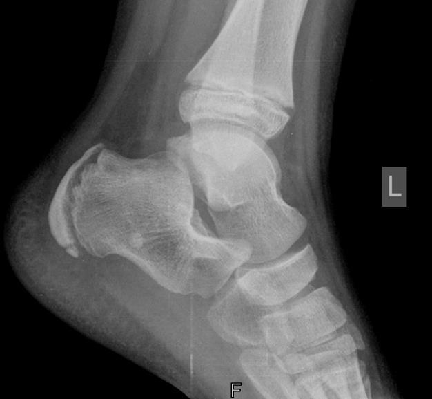 Calcaneus compacta A9.