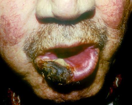 Ajak tumor