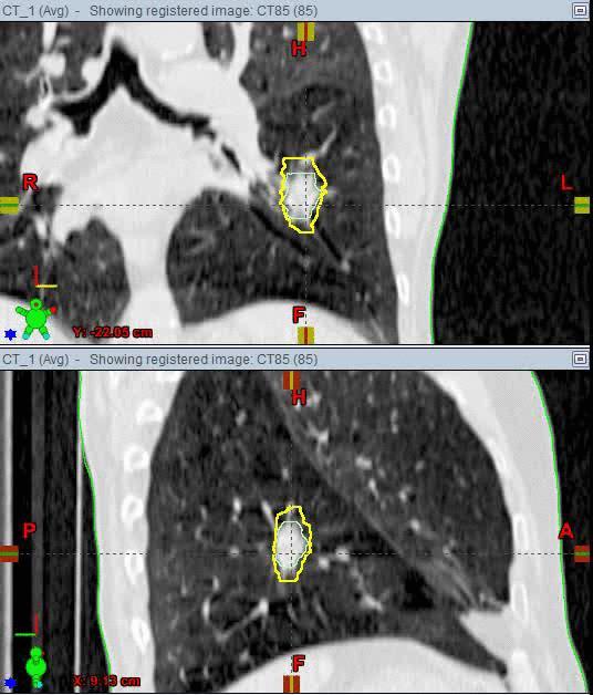 Stereotactic ablative body radiotherapy = SABRT