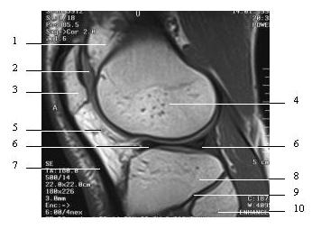 4 4. Párosítsa az alább felsorolt képleteket a megfelelı 15 pont számokkal! A. patella H. meniscus lateralis B. bursa suprapatellaris I.