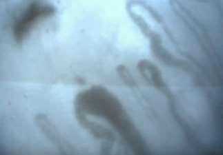 MCTD-s betegek klinikai tünetei Raynaud