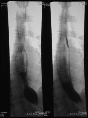 Nyelőcső + GI motilitászavar 66-74 % Nyelőcső dysfunkció Kezdet subklinikus, majd tünetek Nyelőcső dysmotilitás- reflux Nyelőcső alsó szakasz motilitás csökkent Más GI tünet Mesenterialis