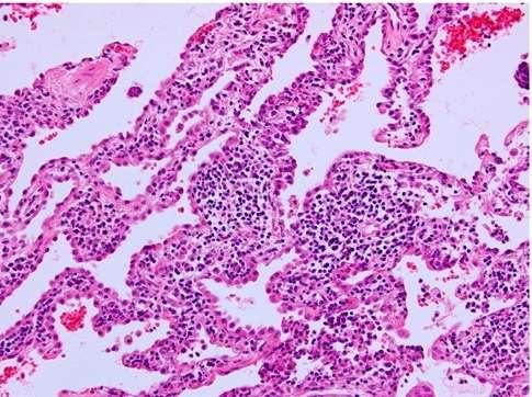 TÜDŐ Interstitiális pneumonitis 55%