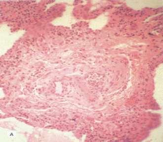 PULMONALIS ARTÉRIÁS HYPERTENSIO (PAH) Idiopathiás Autoimmun betegség 15 /1.000.
