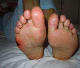 antiphospholipid syndrome.