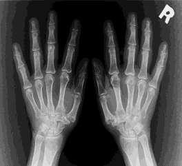Ízületi gyulladás, myositis Terápia KS 1 mg/kg/nap legalább 6 hétig Methotrexát 15-20 mg/hét per os Cyclosporin-A: 2-5 mg/kg/nap Azathioprine:1-3 mg/kg/nap