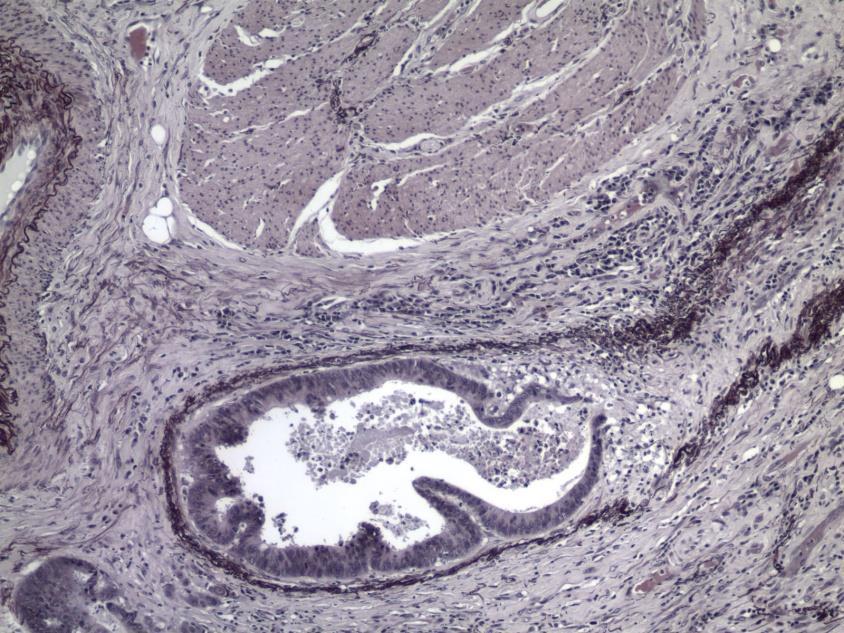 Vasculáris invázió vastagbélrákban Nyirokér invázió Lokális nyirokcsomó áttét jelenlétével függ össze, detektálásának jelentősége polypectomiás mintákban nagyobb CD31, D2-40 Vénás invázió 11%-89,5%