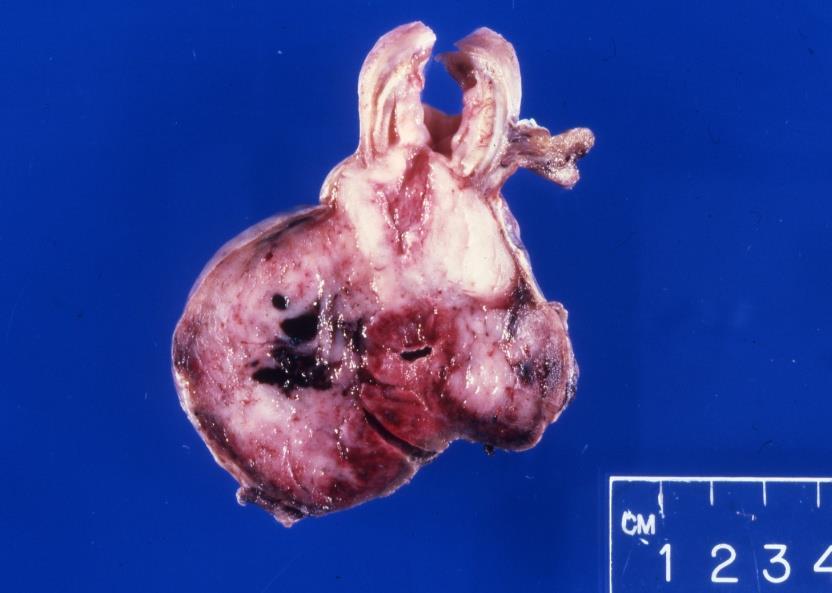 Gastro-intestinalis stromális tumor (GIST)