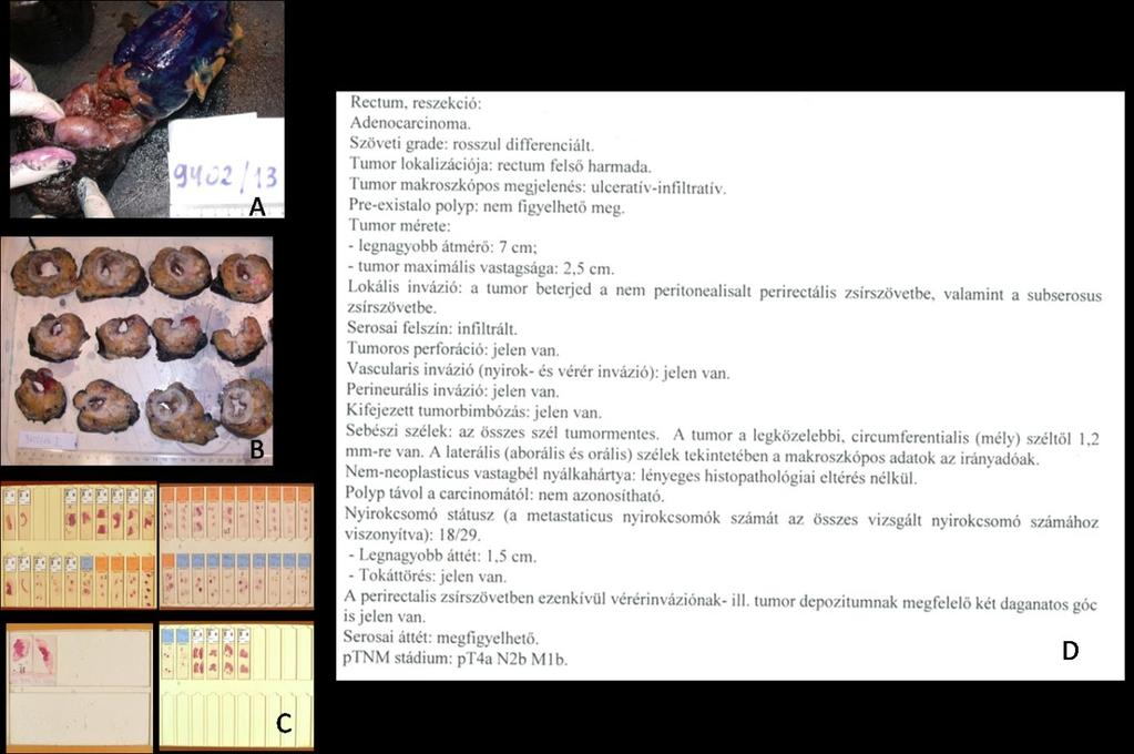 Rectum adenocarcinoma miatt