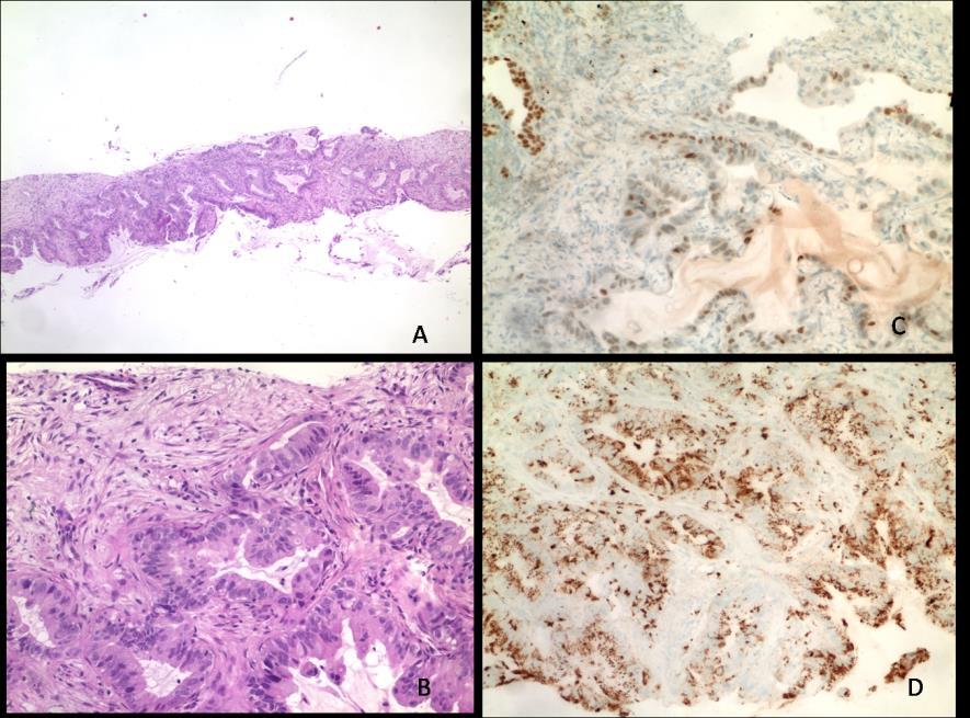 Tüdő adenocarcinoma core biopsziás minta A: HE-festés, 4X. B: HE-festés, 20X.