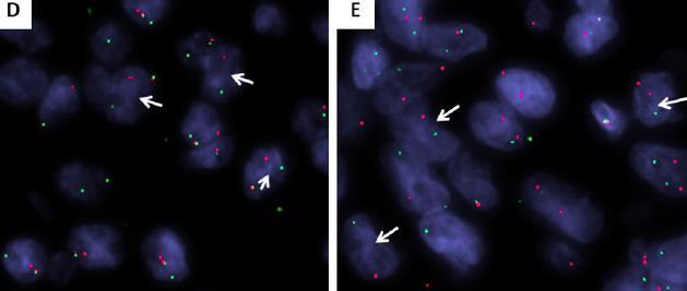 Epithelioid hemangioendothelioma Fúziós gének 1.