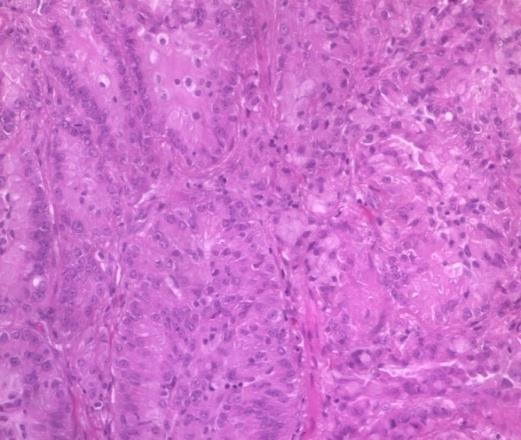 ALK és ROS1 génátrendeződés tüdő adenocarcinomákban EML4 (enichoderm microtubule-associated proteinlike 4) 2p21 és ALK (anaplastic lymphoma kinase)