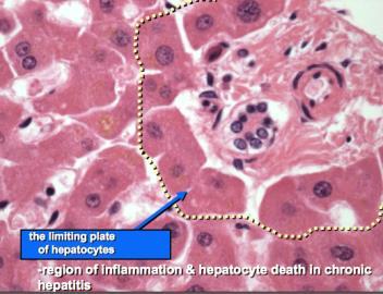 Krónikus hepatitis Mi a fene az a limiting plate?