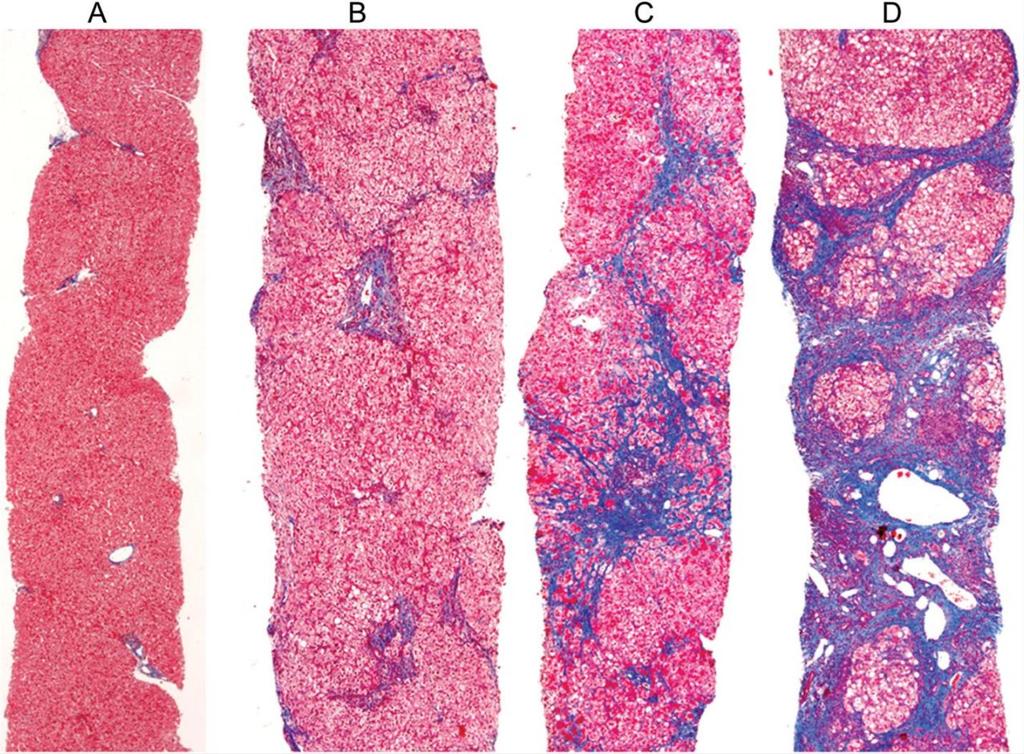 Krónikus hepatitis Fibrosis 0 2 Ishak 4 6 Trikróm festés