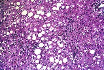 steatosis Batts KP, Ludwig J.