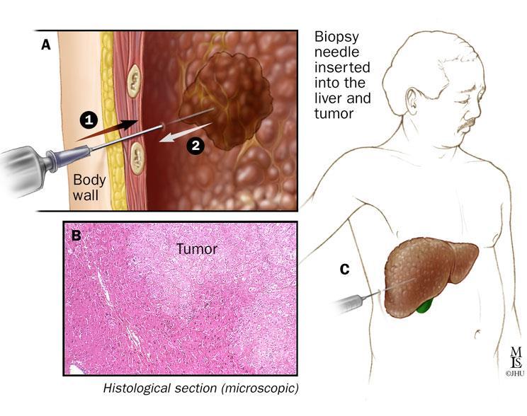 Hepatocellularis carcinoma (HCC) Diagnosztika: képalkotók elsődleges szerepe core biopszia / vékonytű aspiráció Prognózis: medián túlélés 6-9 hónap, 5 éves túlélés ~10-20% Terápia: sebészi (csak