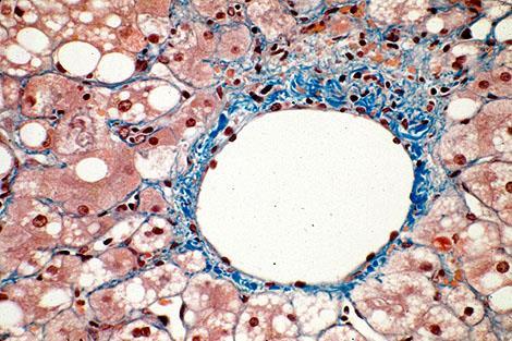 Perivenularis fibrosis v.