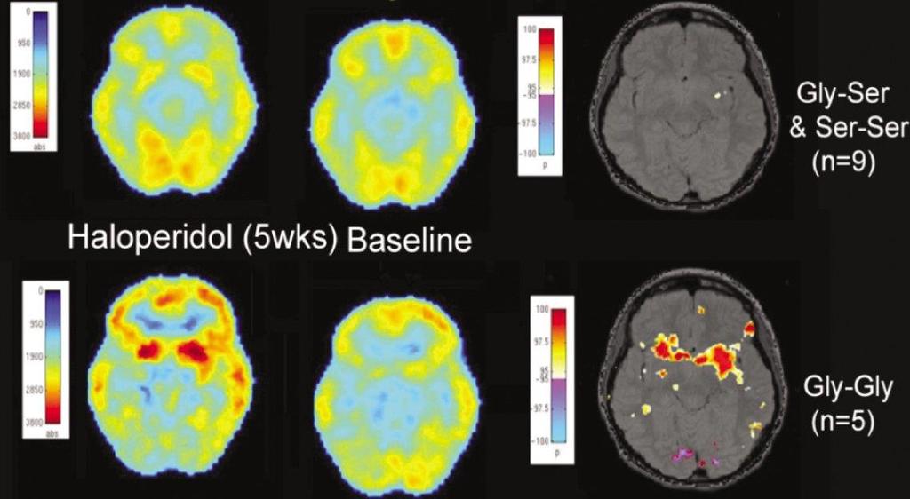 PET vizsgálat: DRD3 genotípusok 5 héttel Haloperdiol adását követően nagyobb FDG-vel mérhető aktivitást találtak a BG-ok területén a Dopmaine 3 receptor gly9gly