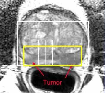 LOKÁLIS STAGING - prostatectomia vs. RT?