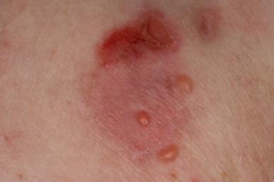 az endoparaziták az ektoparaziták példái a diphildobothriasis életciklusa
