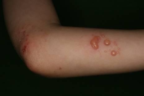 holyagos bőrbetegség helmint terápia a crohn-betegségben