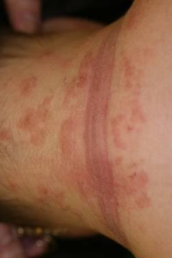 Erythema ± hólyagok