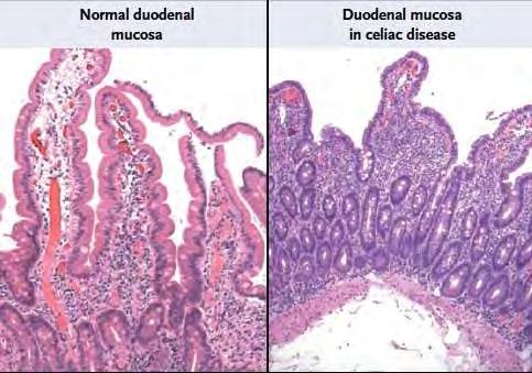 COELIAKIA http://blogs.nejm.