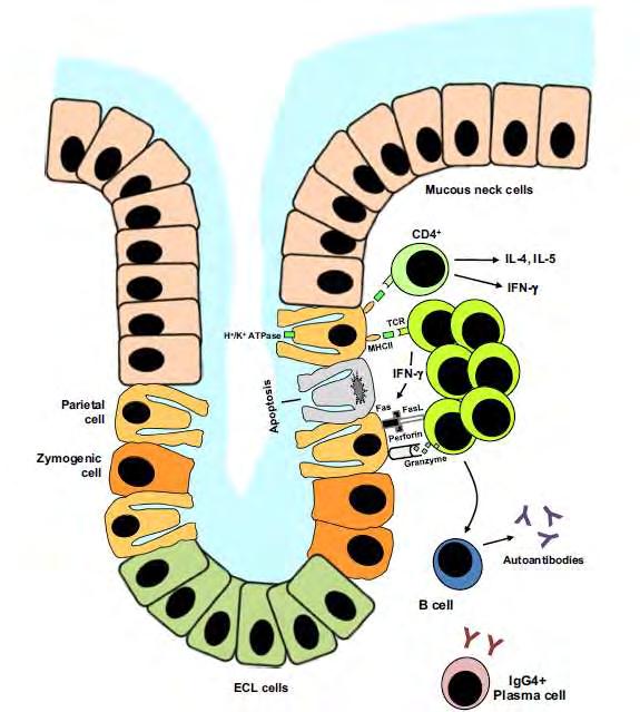 AUTOIMMUN ATROPHIÁS GASTRITIS Di Sabatino A, et al.