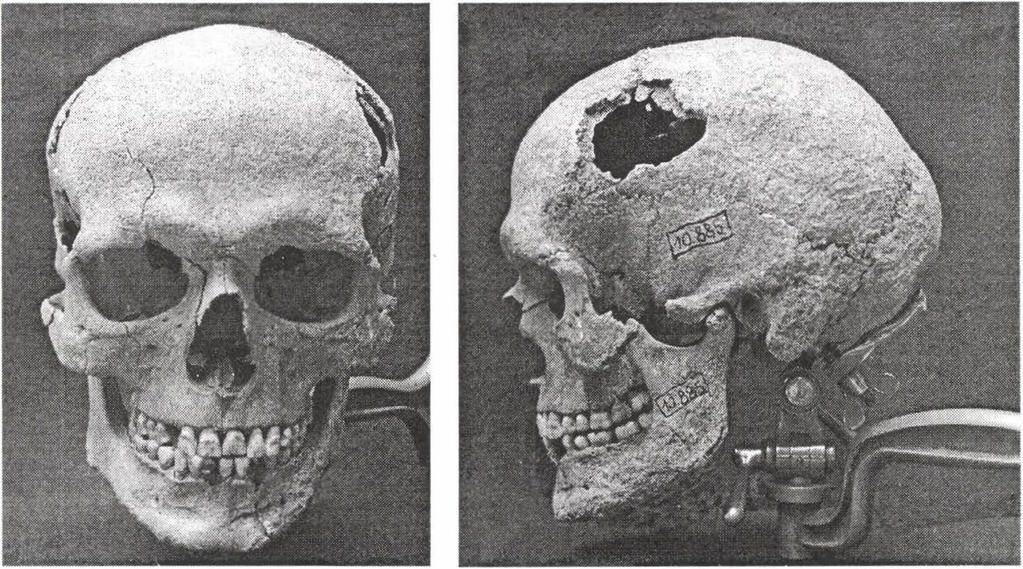 Figure 1: Grave 8, mature male (frontal and lateral view). 2. ábra: 11.
