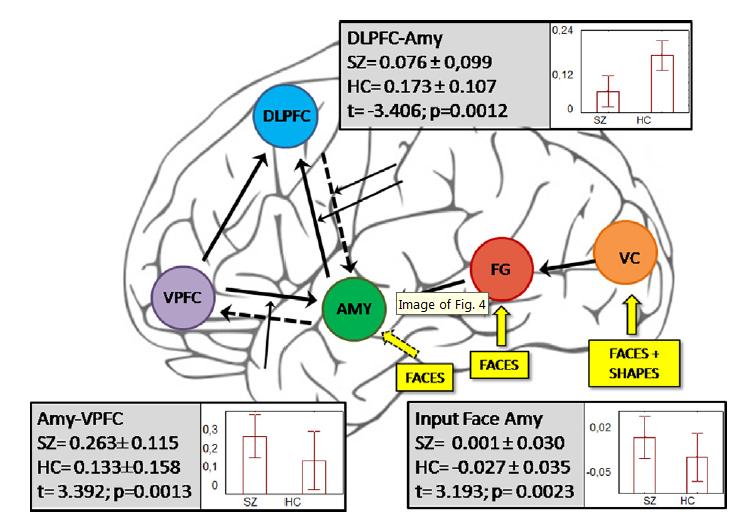 Abnormal cortico-limbic connectivity during emotional processing correlates with symptom severity in schizophrenia Patients with SZ showed significant reduced intrinsic connectivity from DLPFC to