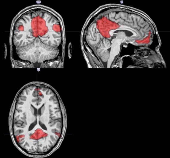 Default mode network (DMN) / Feladatnegatív Funkcionálsi hub-ok: Információfeldolgozás az Én -nel kapcsolatban Precuneus és a Posterior cingulate cortex (PCC) Medial prefrontal cortex (mpfc) Angular