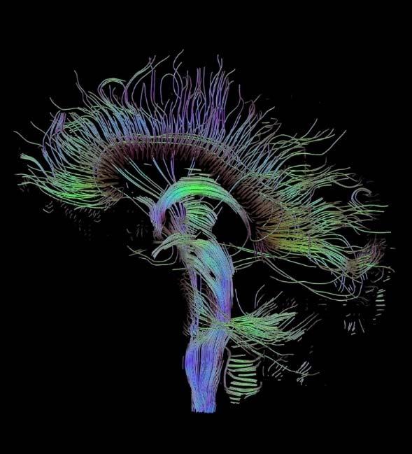 Diffúziós tenzor képalkotás Diffusion Tensor Imaging (DTI) / diffúzós tenzor képealkotás egy új ígéretes eljárás melyet az Alzheimer kór illetve az enyhe kognitív zavar korai felismerésében már